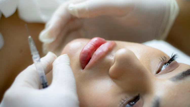 Lip Filler: Všechno, co potřebujete vědět o zvětšení rtů kyselinou hyaluronovou